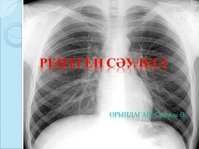 рентген сәулесі ОРЫНДАҒАН: СЕЙДУАЛЫ Ә. рентген сәулесі ОРЫНДАҒАН: СЕЙДУАЛЫ Ә.